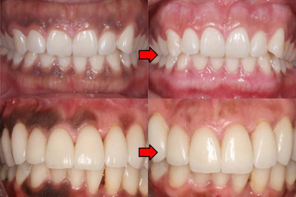 歯肉ホワイトニング